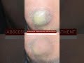 Think Abscess Drainage Treatment Is Too Good to Be True? We Have News for You | viral #shorts
