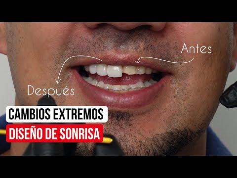 Diseño de sonrisa: Cambios extremos 🤩