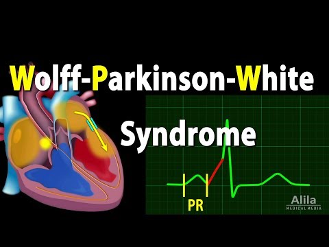 Learn Wolff Parkinson White Syndrome Pathophysiology Pre Excitation and ...