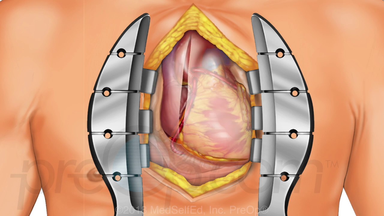 Coronary Artery Bypass Graft (CABG ) Off-Pump PreOp® Patient Education