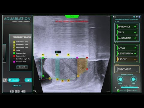 New robotic treatment for enlarged prostates