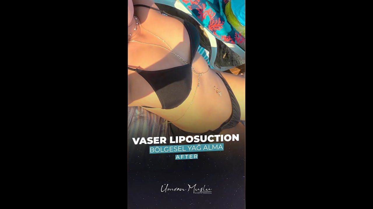 Liposuction & Vaser Liposuction