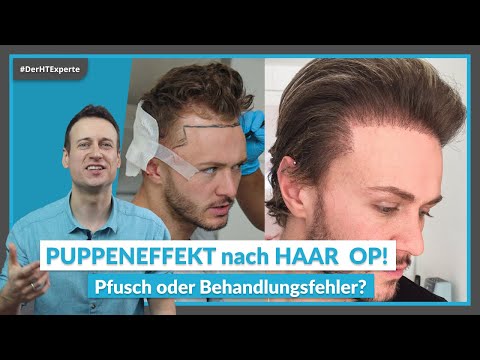 How DANGEROUS is a hair transplant? | RISKS & SIDE EFFECTS at a glance