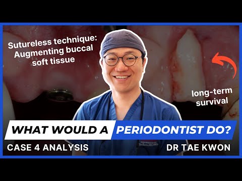 What Would A Periodontist Do? - Clinical Case 4