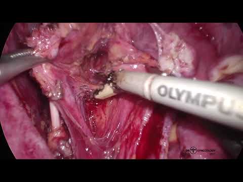 Cervical Cancer: Laparoscopic Radical Hysterectomy Unedited Version