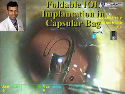 Primary Posterior Capsulorhexis for Posterior Capsule Plaque