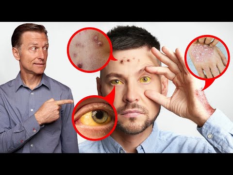 How Your Feet Are Warning You About Your Liver Problems Dr Berg Explains