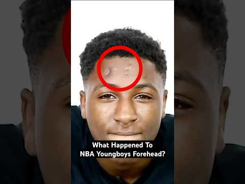 What happened to NBA YoungBoy's forehead? 🤔