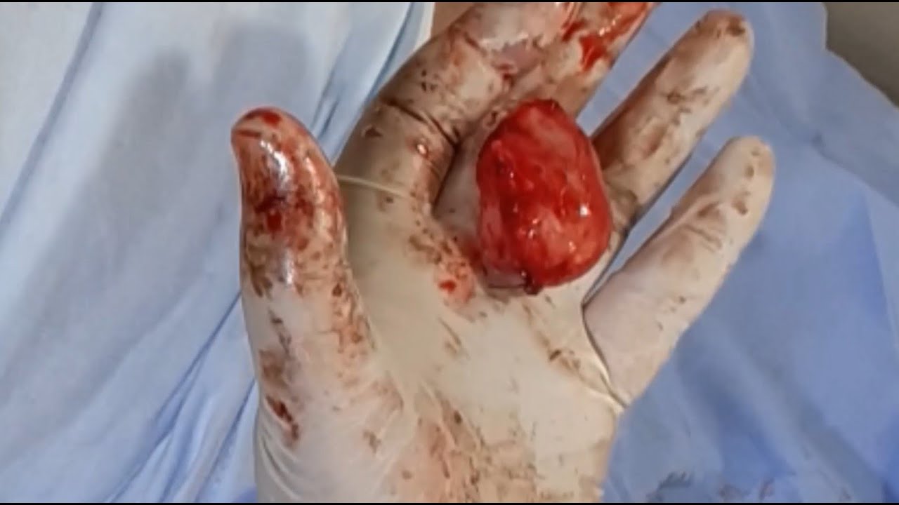 عملية استئصال كيس على الحبل المنوى فى الخصية ب مخدر موضعى - فيديو 168 - قناة د/ أيمن زغلول هزّاع