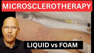 Microsclerotherapy Breakthrough: Is Foam The Future of Spider Veins? Plus a Simple Dilution Trick