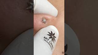 Small Ear Pimples, Big Discomfort 😱 #shortvideo #skincare #blackhead #satisfying
