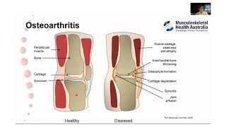 Musculoskeletal Health Awareness Month - The Link Between Heart Disease and Arthritis