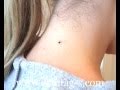 Skin Tag Removal in 15 Mins @ Home! 