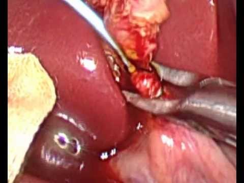 Laparoscopic cholecystectomy with intraoperative cholangiography Video