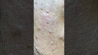 Huge Temple Acne Removal #skincare #satisfying #blackhead #treatments #shortvideo