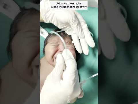 NG tube / feeding tube insertion in a newborn | pediatrics #newborn #shorts  #thebabydoctor