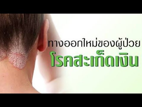 มือกลากแห้งในรูปภาพ ครีมสำหรับข้อศอกโรคสะเก็ดเงิน