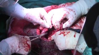 Difficult Caesarean Sections