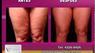 Tratamiento para eliminar flaccidez y grasa en Piernas