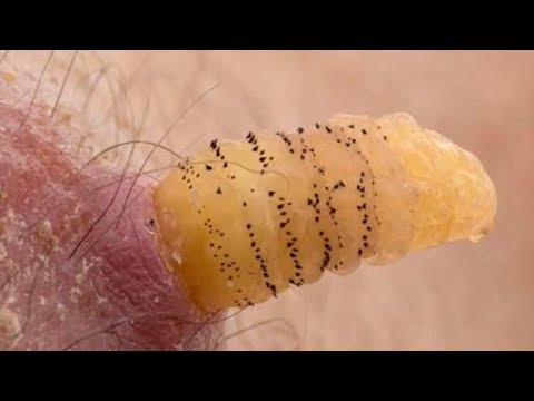 Pinworm kezelés tünetei