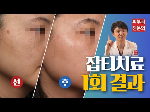 잡티한방! 이런 잡티들은 1번만 치료해도 말끔하게 없어집니다!