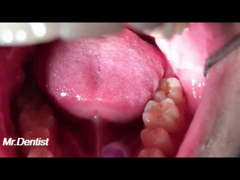 Tooth Filling Procedure - Composite Materials