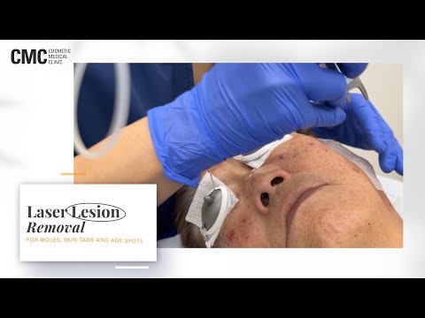 Laser Skin Lesion Removal