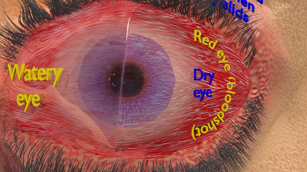 3D thyroid eye disease 3D Model
