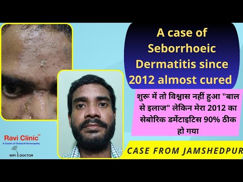 Seborrhoeic Dermatitis 90 % cured