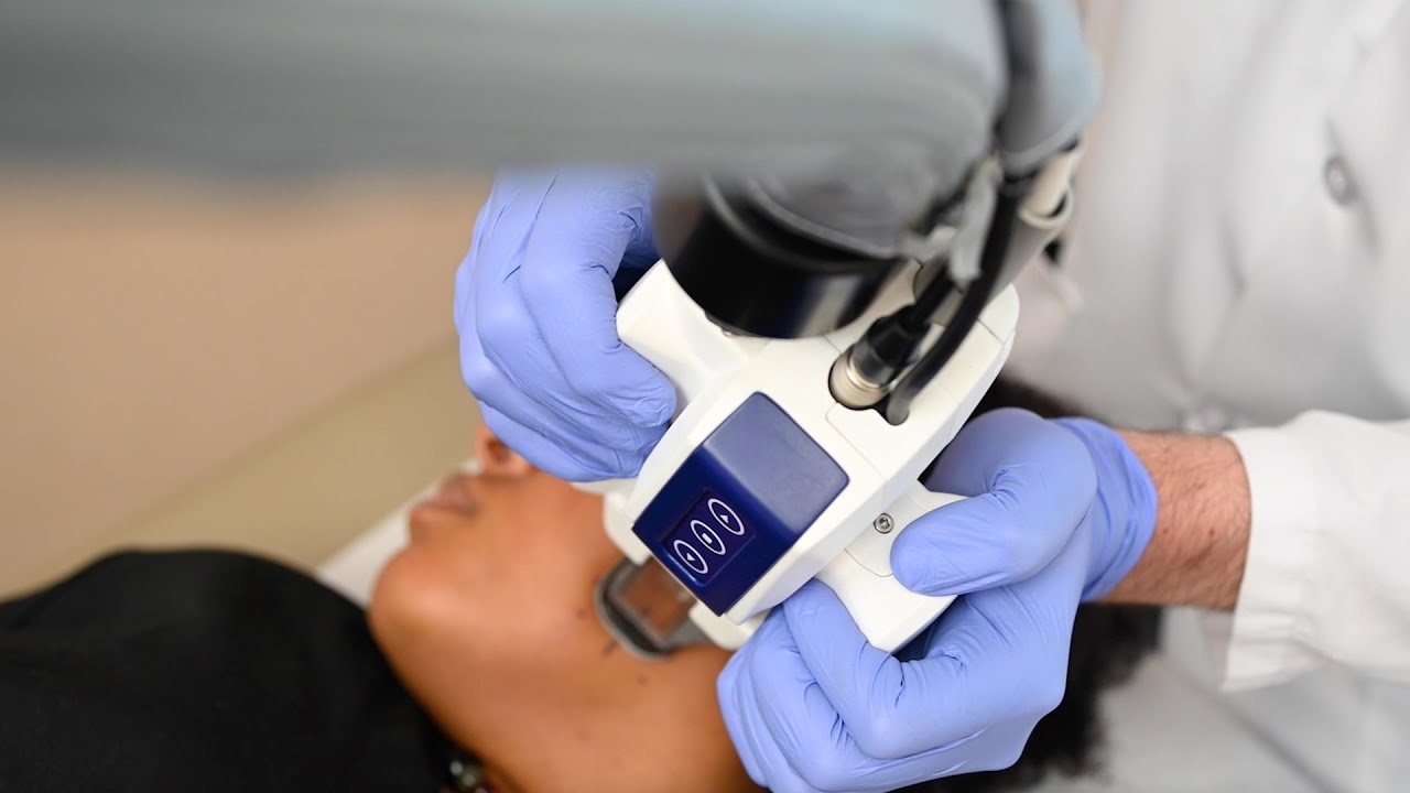 Accure Laser for Acne l Milburn Laser Center