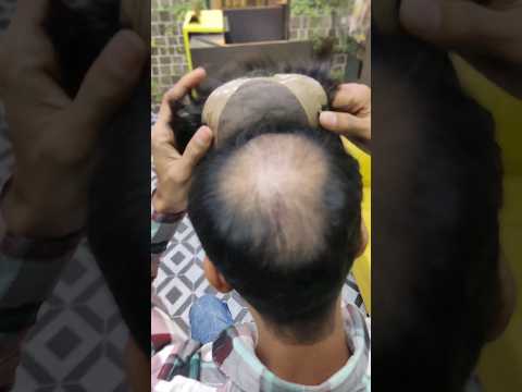 Best Clipping Hair Patch System | Delhihairfixing #hairpatch #hairtransplant #hairtechniques