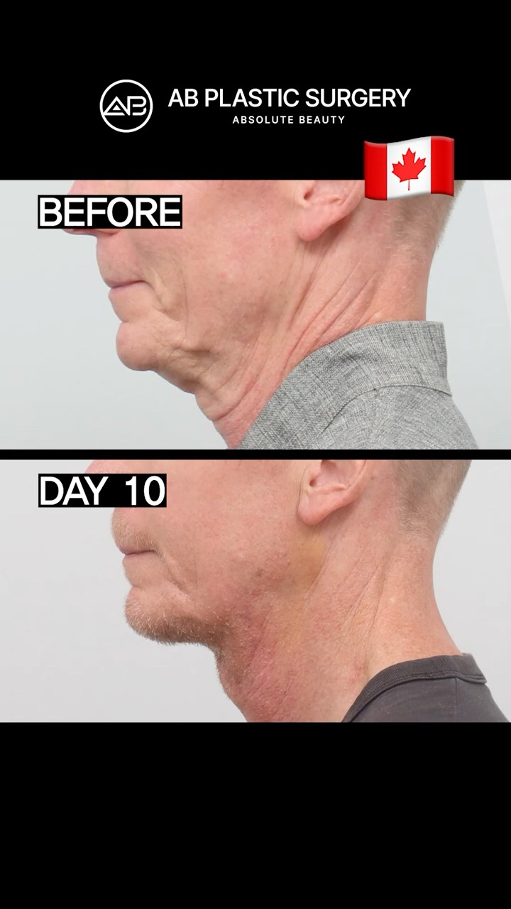 He UNLOCKED His Masculine Jawline! 🤯