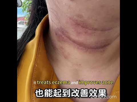 Eczema user product experience.. 