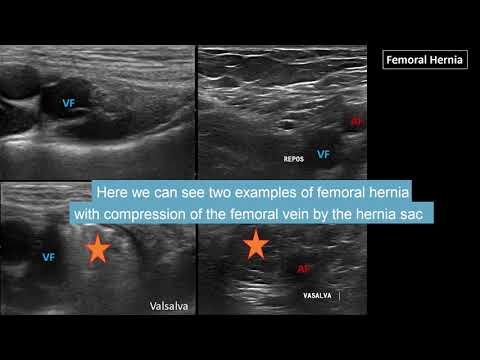 Groin pain and ultrasound - part 2 - Inguinal, femoral & sport hernia