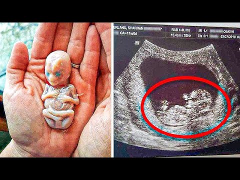 ELLE ÉTAIT SÛRE DU SEXE DE SON FUTUR BÉBÉ, MAIS LES CHOSES NE SE SONT PAS PASSÉES COMME PRÉVU