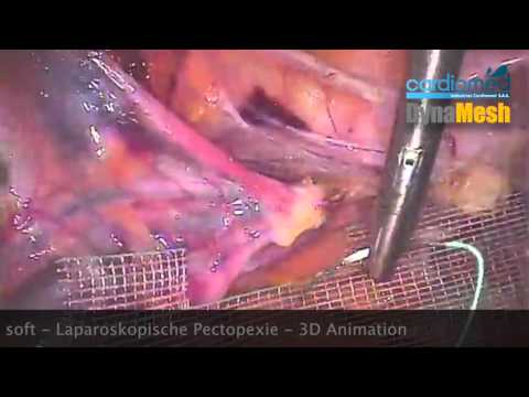 DynaMesh® PRP soft   Laparoskopische Pectopexie   3D Animation
