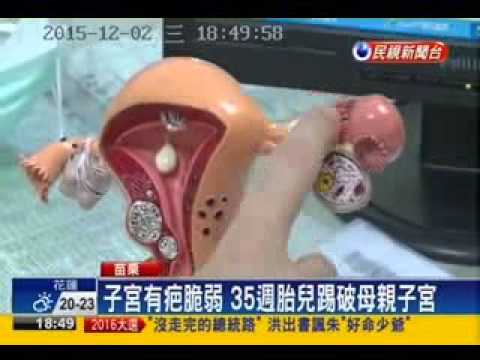 104 12 02民視新聞：35週胎兒無影腳踢破媽媽子宮