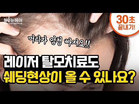 탈모약 쉐딩현상, 레이저치료 받아도 나타날까? l 뉴헤어