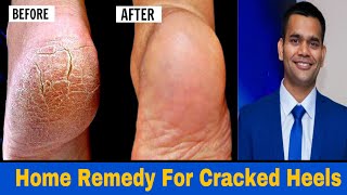 Home Remedy To Get Rid Of  Cracked Heels Fast