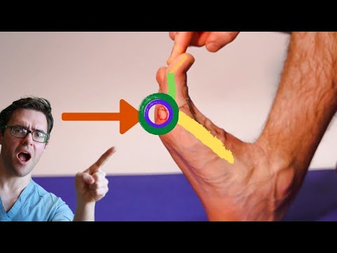 BEST 25 Plantar Fasciitis HOME Treatments Massage Stretches Shoes