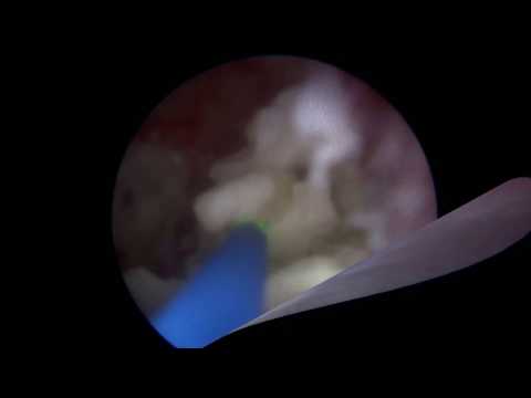 Ureteroscopy And Holmium Laser Lithotripsy