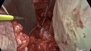 Core Videos (2024): Open Radical Cystoprostatectomy