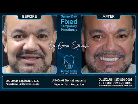 All on 6 Dental Implants - Perfect Smile Implant Center - Tijuana, Mexico