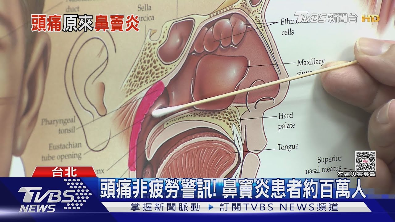 百萬人受苦！鼻竇炎不只流鼻涕　「頭痛位置」藏玄機快檢查