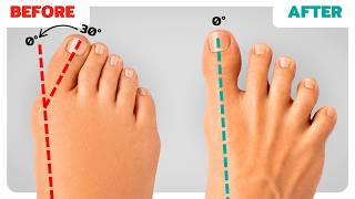 99% of People STILL Don’t Know the Basics of Fixing Bunions