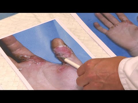 Weißer Phosphor - gefährliches Strandgut an der Ostsee | AFP