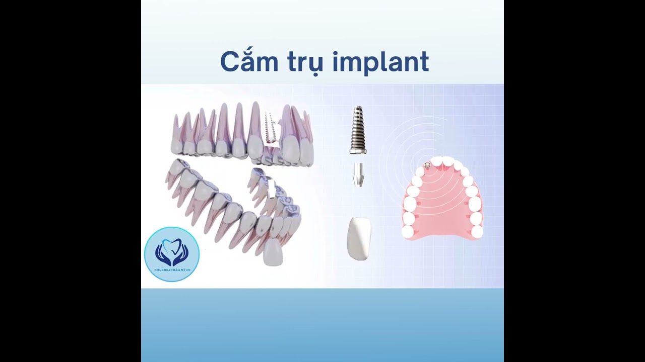 implant mô phỏng 3d - Nha khoa thẩm mỹ 470