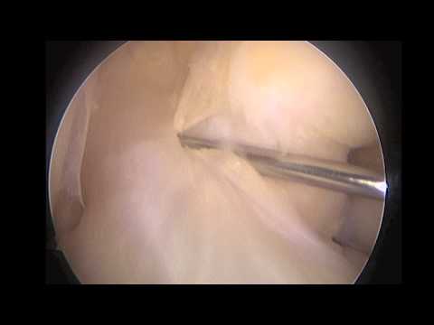 Anatomiczna metoda rekonstrukcji więzadła krzyżowego przedniego