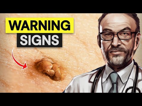 How to Remove Skin Tags and Warts Overnight