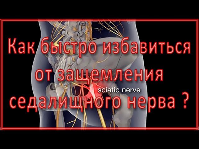 Защемление седалищного нерва: симптомы и лечение в домашних условиях